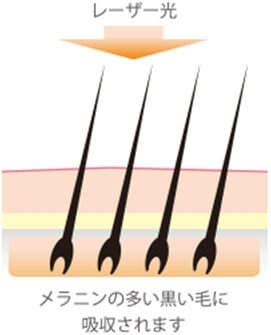 医療レーザー脱毛