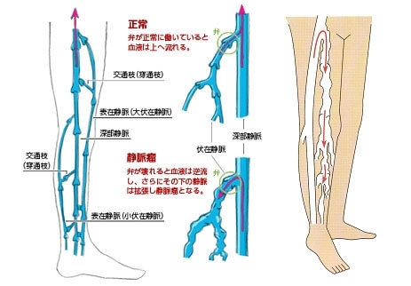 下肢静脈瘤とは