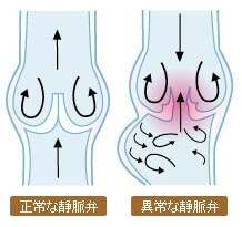 下肢静脈瘤の原因