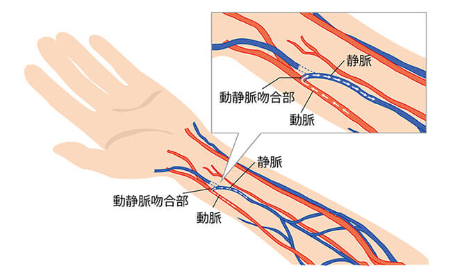 シャントの日帰り手術を行っています