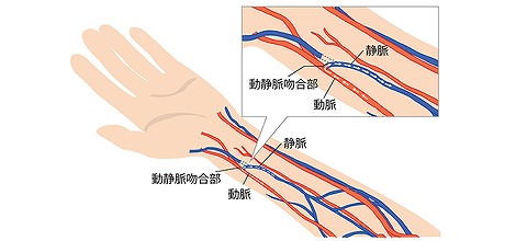 透析シャント専門外来