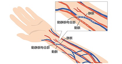 透析シャント専門外来