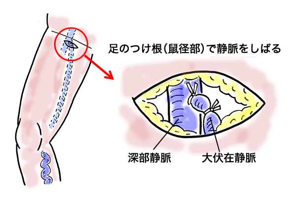 高位結紮術