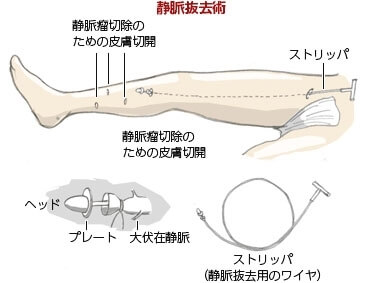 ストリッピング手術