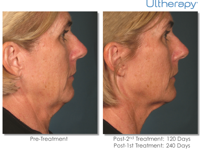 藤沢市 大和市でウルセラリフトなら湘南藤沢心臓血管クリニックへ